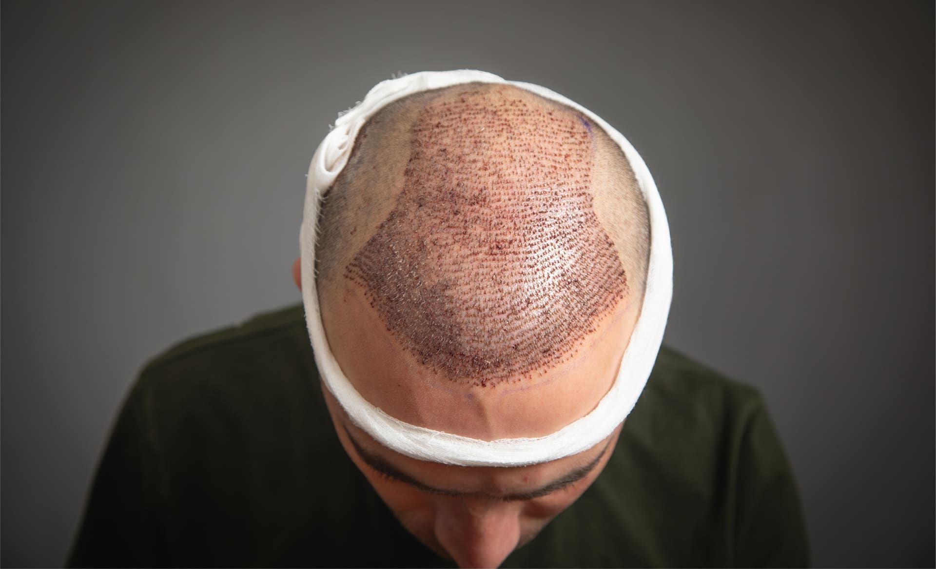 5 VIP Tips to Speed Up Recovery After a Hair Transplant