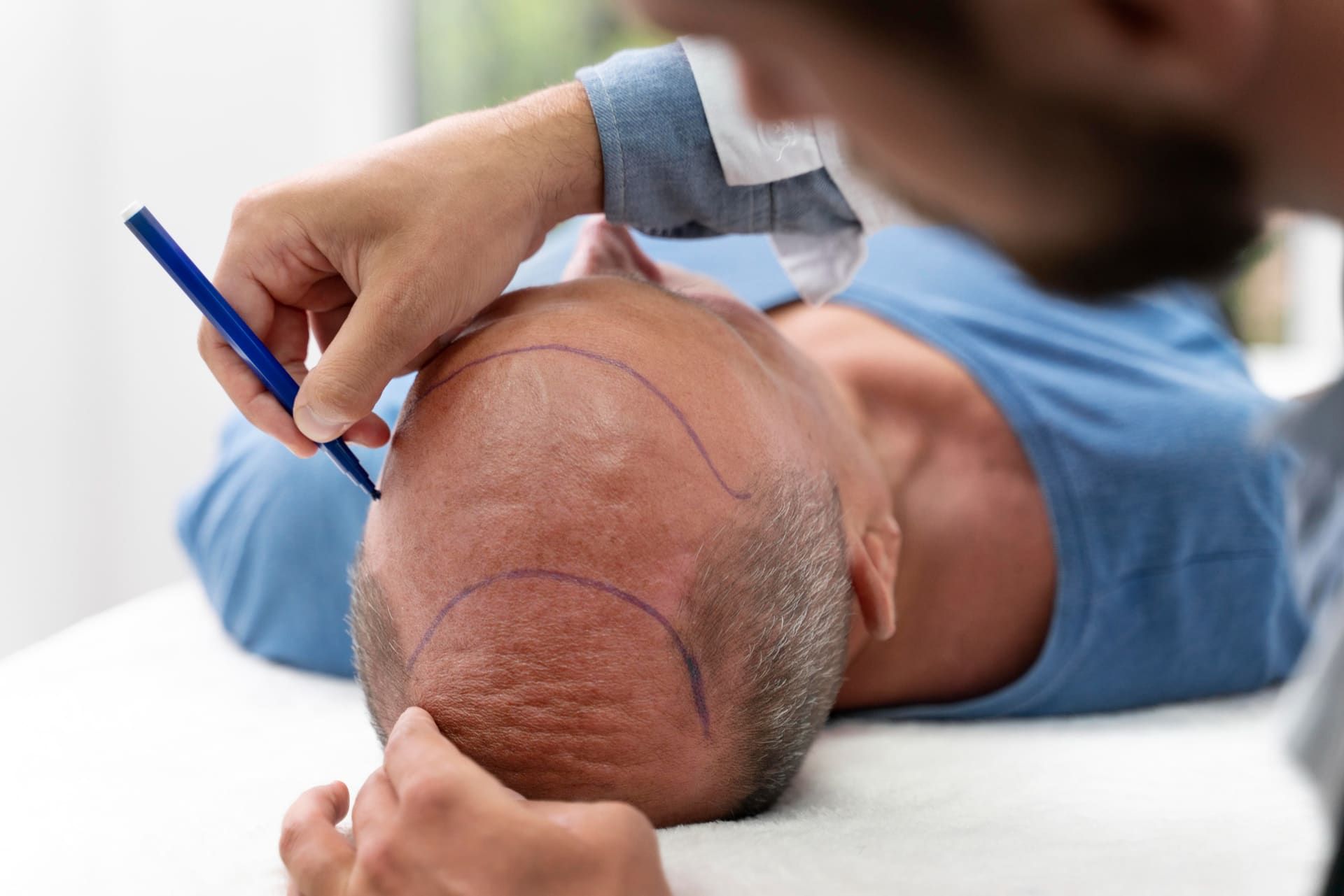 Hair transplantation