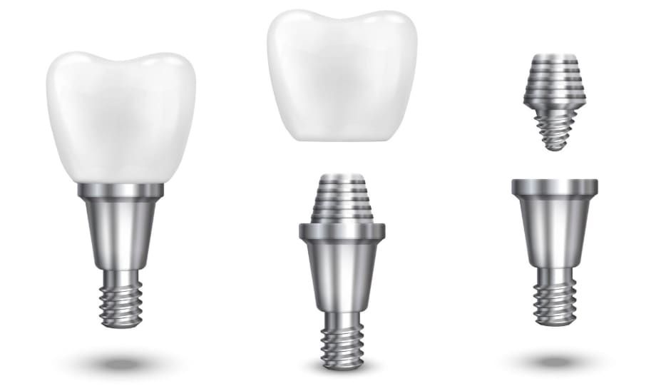 Implants & smile design